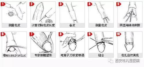 男人做包皮手术视频,真实视频解析