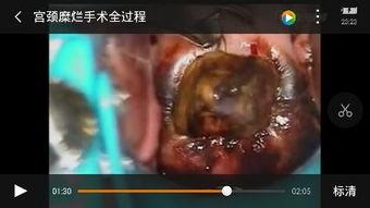 宫颈糜烂视频手术